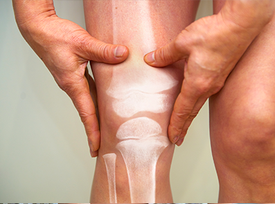 Остеоартрит